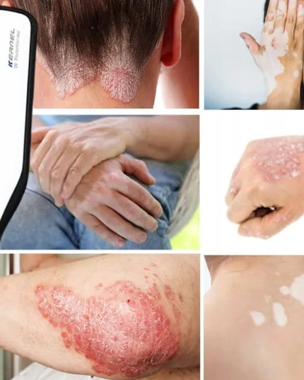 Kernel UVB 311 nm gydomoji lempa KN-4006BL1D nuo psoriazės, vitiligo, egzemos, atopinio dermatito ir židininės alopecijos
