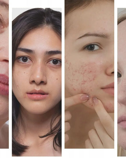 Immetee Retinol serum veidui – regeneracija, kova su aknės randais ir raukšlėmis
