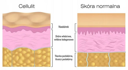 Dvigubas smūgis celiulitui